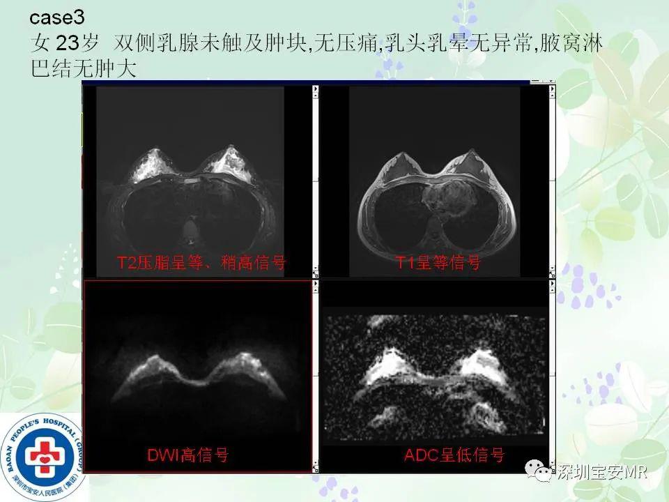 乳腺磁共振扫描