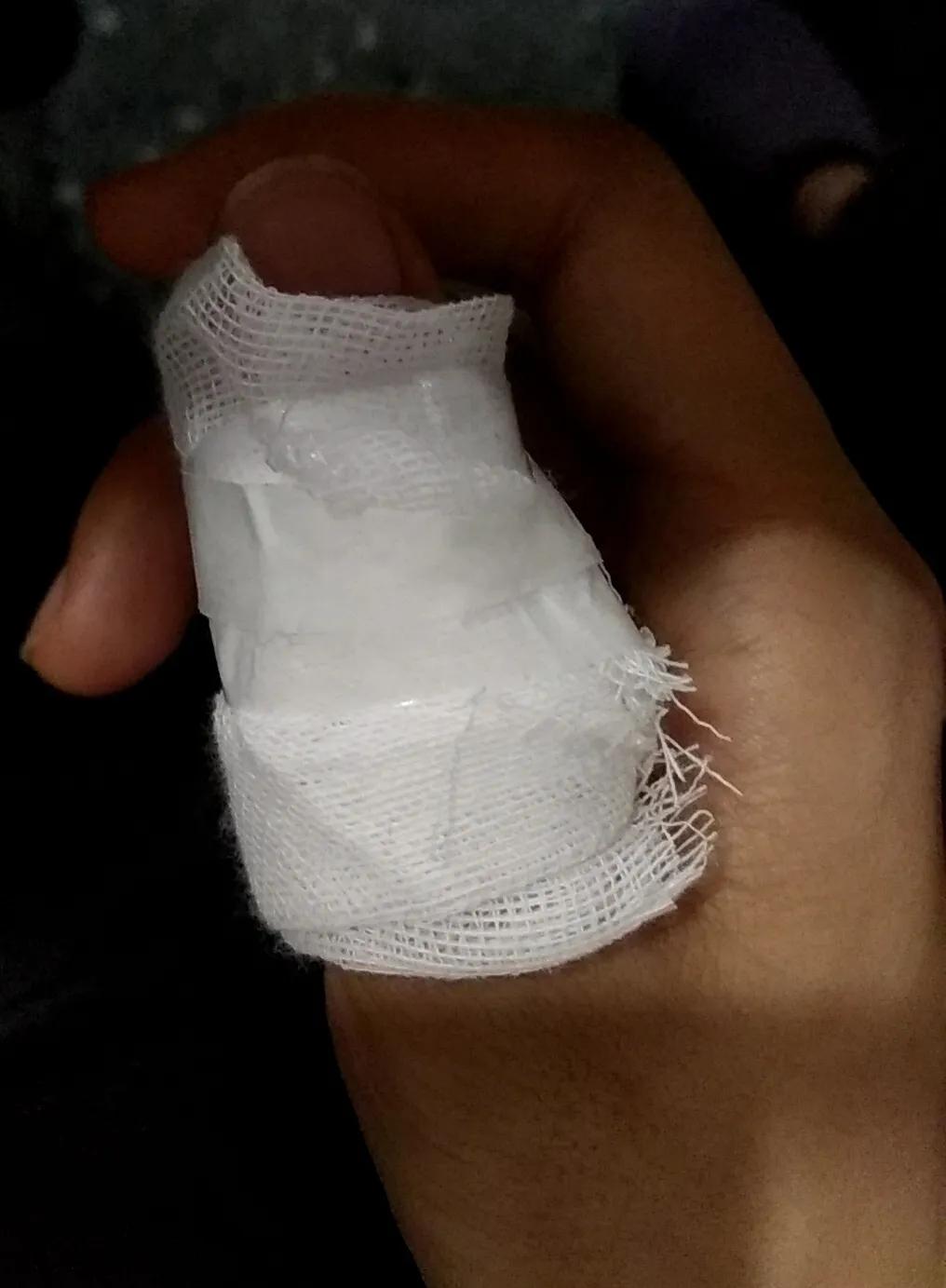 大拇指被刀砍伤,幸好有手电筒挡着,手指只被砍出了两厘米左右的伤口