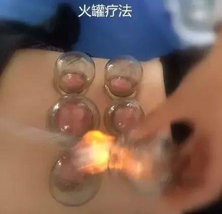 拔罐疗法●蜡疗▲蜡疗机●各种物理治疗设备(电针,牵引,中频,微波