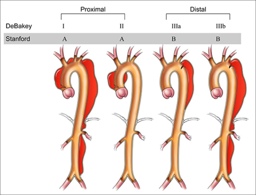 图2. 主动脉夹层的分型