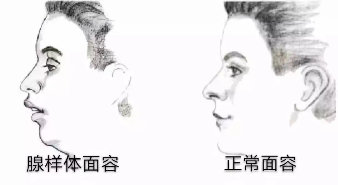 「睡眠」得治宝宝打呼噜是睡得香？这是病