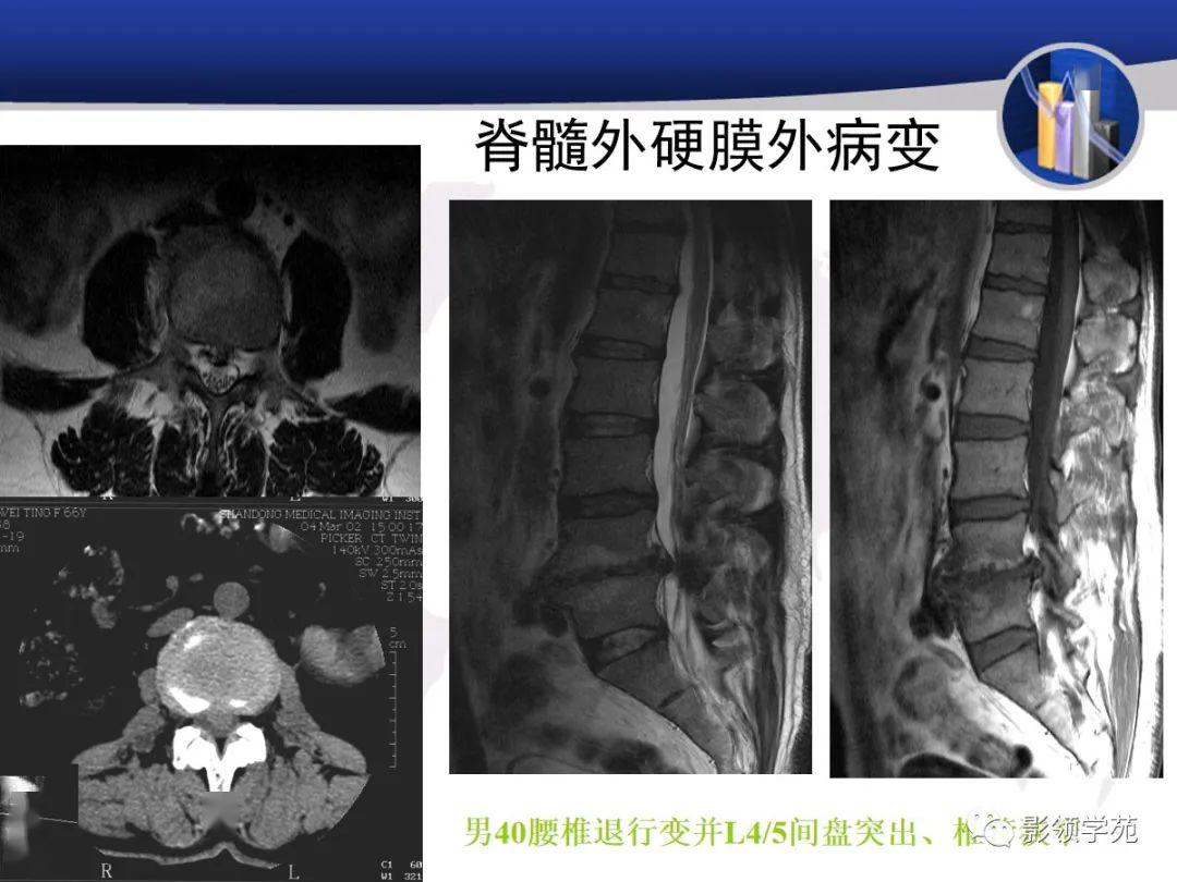 脊髓和椎管内病变影像诊断