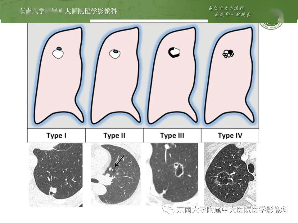 z型腔怎么搭_囗腔溃疡怎么治疗