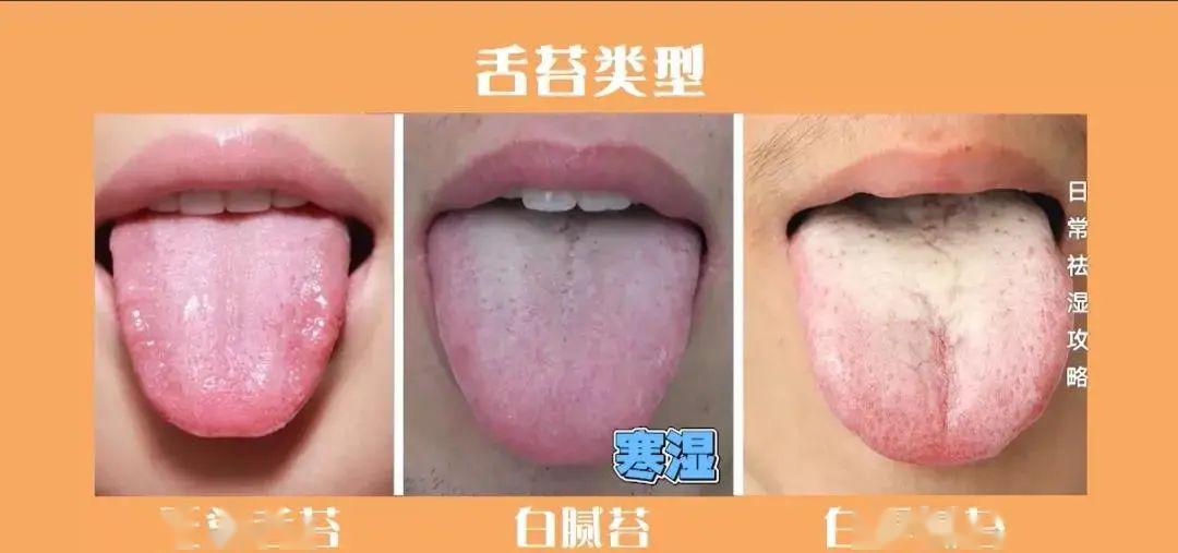 体湿的人观察舌头时会发现  有齿痕,舌苔白腻或黄,厚腻.