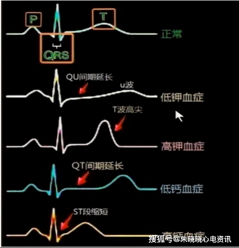 低镁血症的心电图改变 · qtc间期延长; · 房早,室早; · 尖端扭转