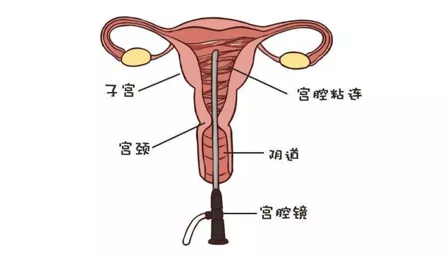 宫腔粘连如何接好孕?