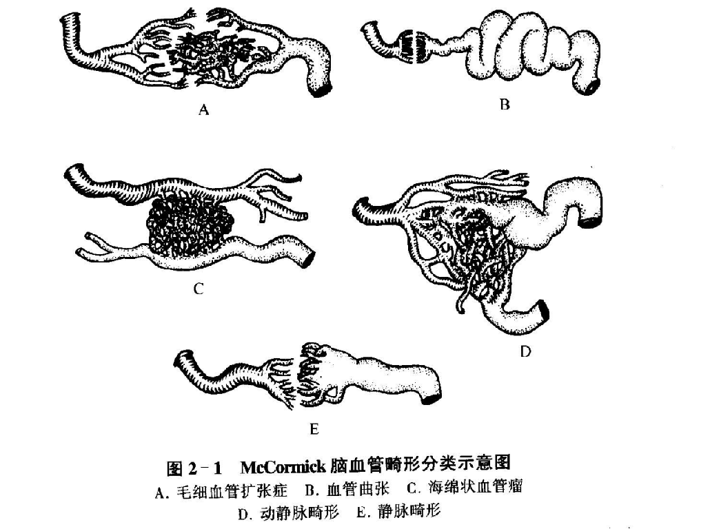 脑血管畸形的分类(mccormick) 动静脉畸形(avm)  毛细血管扩张症