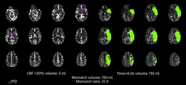 rt-PA直接机械取栓有望提高患者救治率急性缺血性卒中防治取得新进展