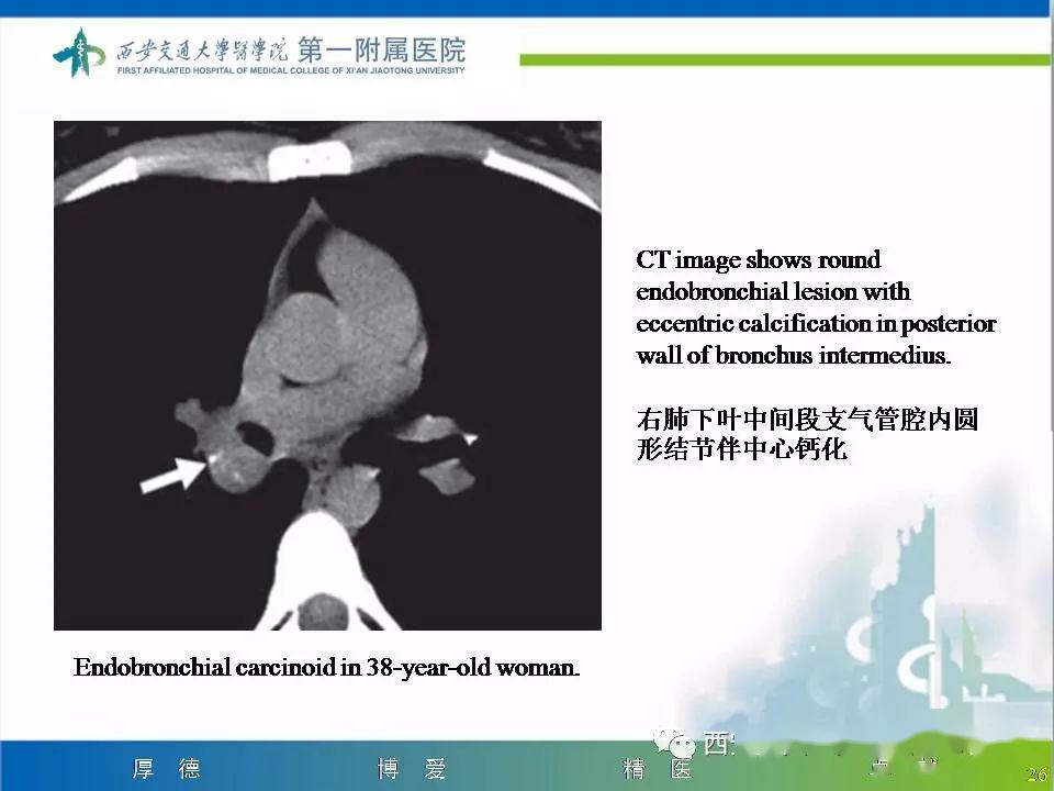 精彩病例气管腺样囊性癌