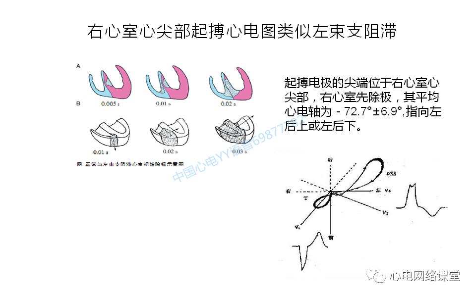 20200511白敏聪老师被忽略的起搏电极脱位心电图表现