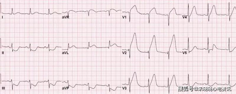 急性心梗的5类心电图表现_墓碑