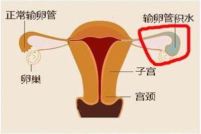 如果继发感染,炎症可以通过直接蔓延,引起盆腔广泛的损伤粘连.