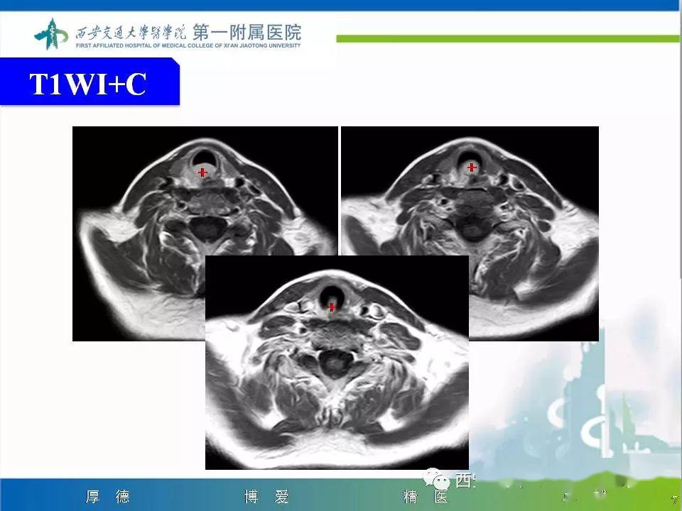 精彩病例气管腺样囊性癌