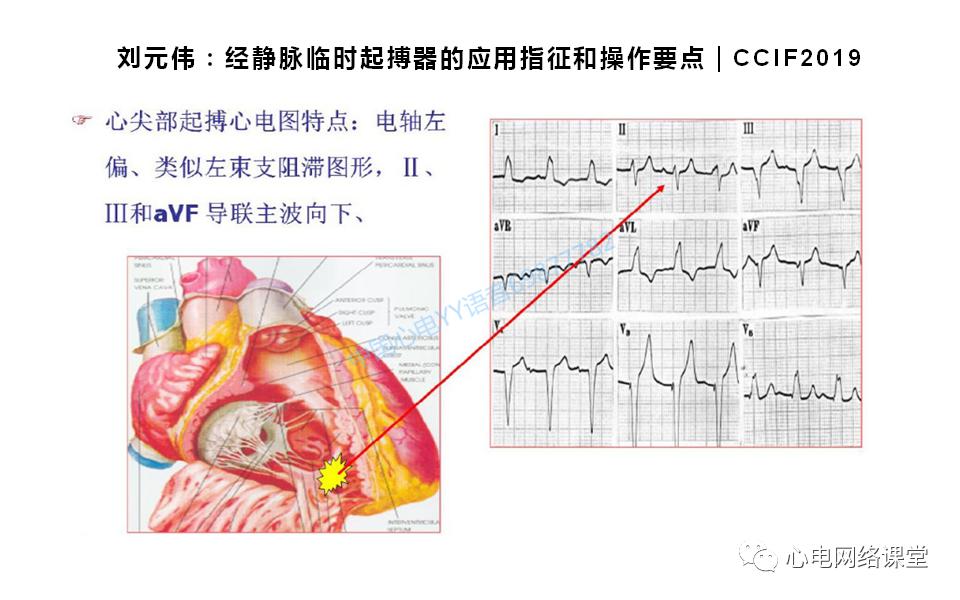 20200511白敏聪老师被忽略的起搏电极脱位心电图表现