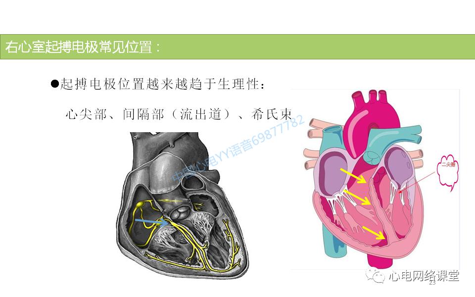 20200511白敏聪老师被忽略的起搏电极脱位心电图表现