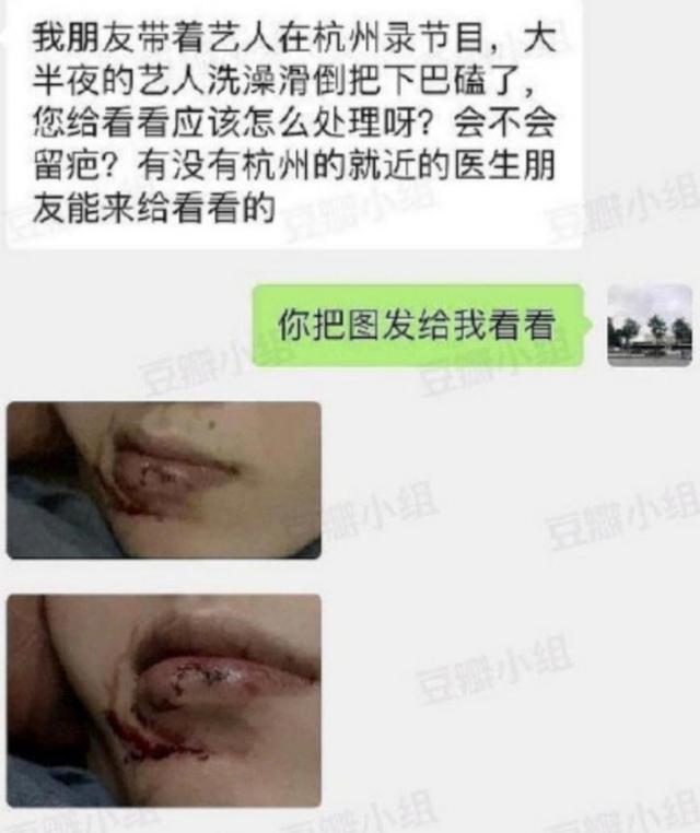 网曝范丞丞摔伤下巴？伤口血迹明显，带伤出席