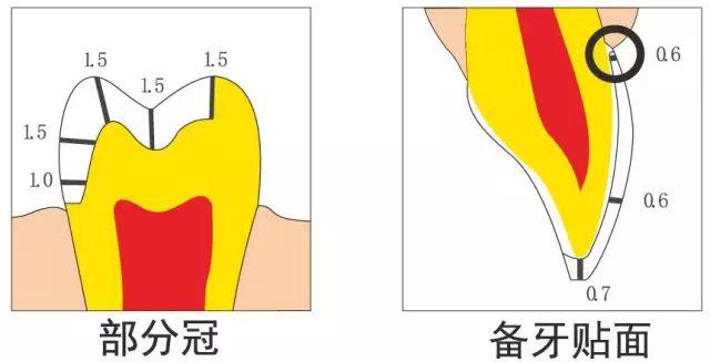 二,全瓷牙备牙要求连冠或桥冠体制备时,共同就位道的取得和倒凹的消除