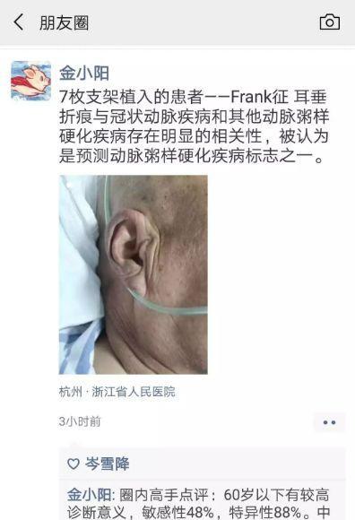 耳垂上有折痕可能有冠心病听起来像谣言,医生却说是真的!