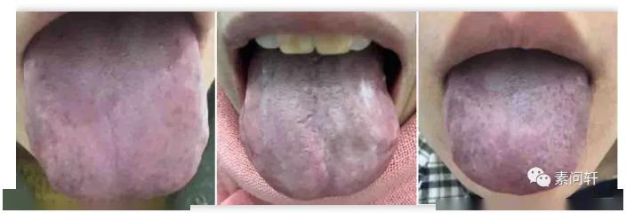 舌质黯紫舌底有淤络的要注意了,不调理,可能会得肿瘤,心梗,不孕,中风.
