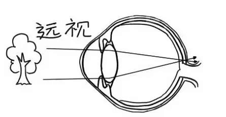 眼睛的前后轴较短,眼睛所看到的景物是聚焦到视网膜的后方,都处于远视