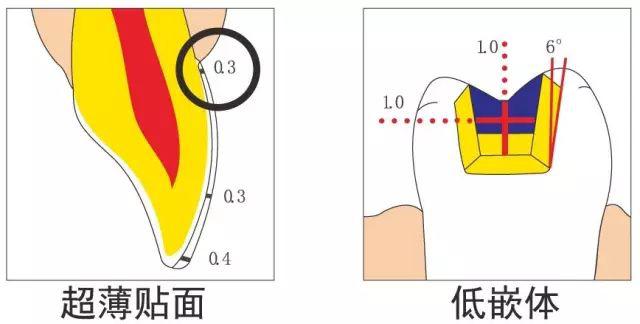 各个基牙选取一个共同的牙体长轴,制备每颗牙以