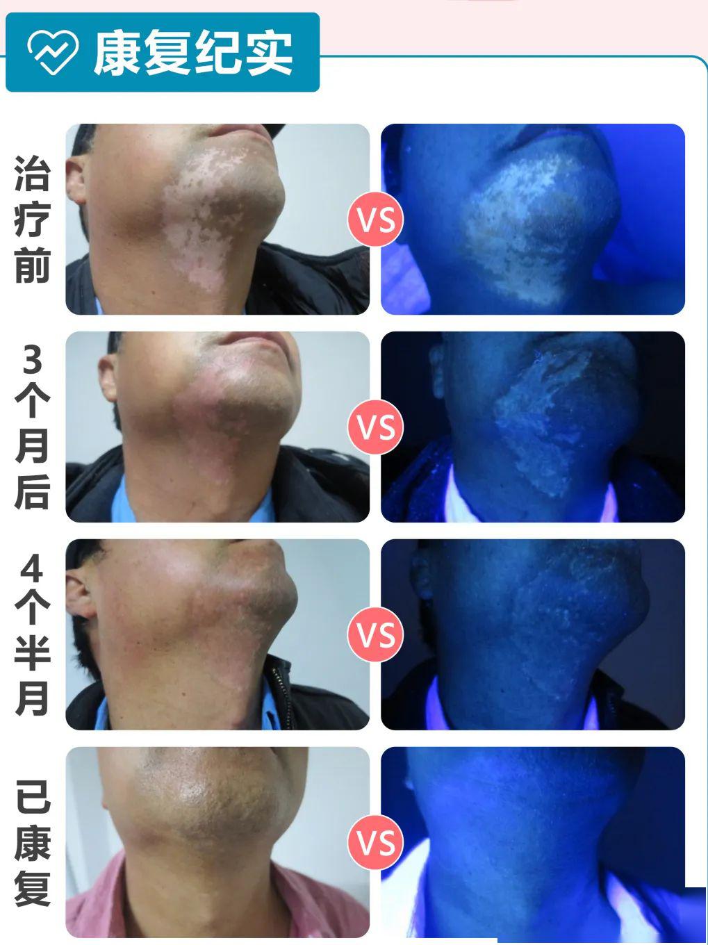 招募对象 身上有白斑白块未确诊者; 未接受正规治疗,白斑扩散者