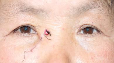 泪囊炎是一种常见眼病,好发于中老年女性,长期慢性流泪,流脓对患者的