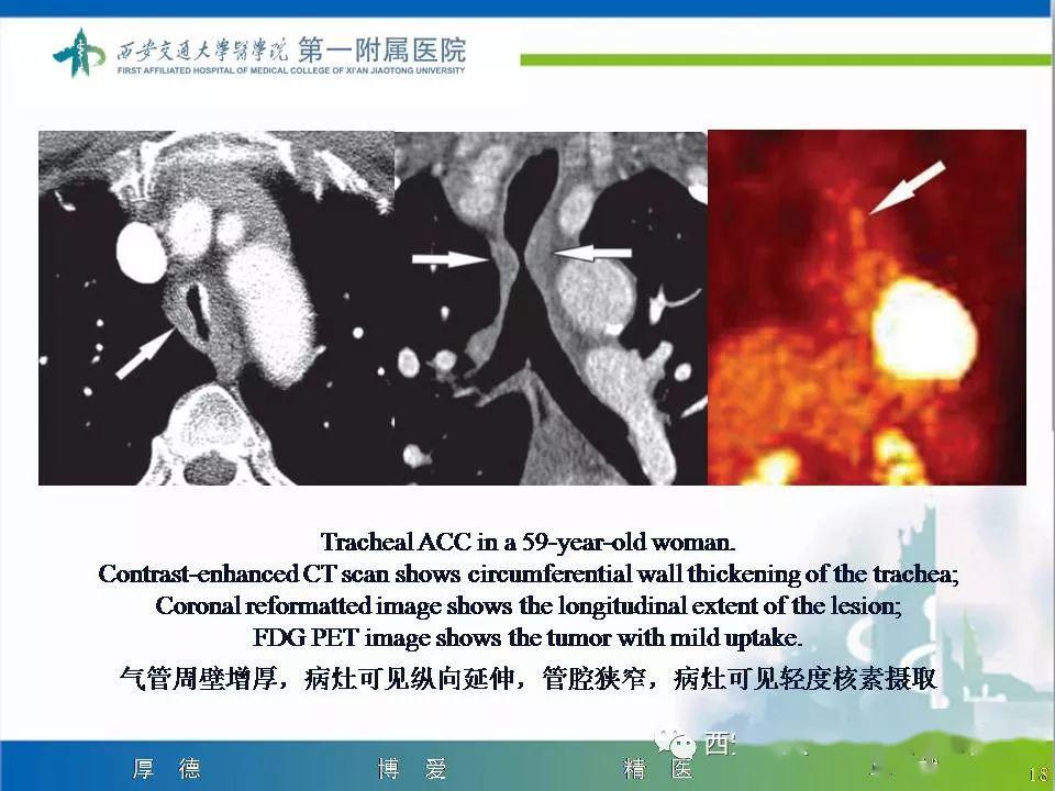 精彩病例气管腺样囊性癌