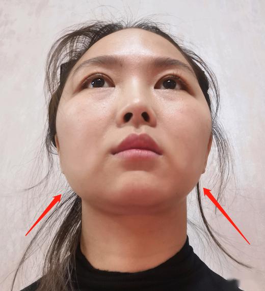 所以,可以通过瘦脸针来平衡一下左右两边的咬肌.