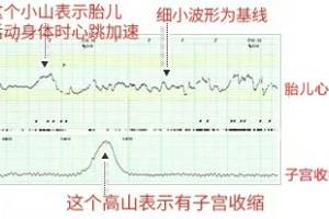 胎心监护报告怎么看:结果不理想有2大原因