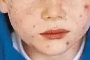 孩子皮肤出现小红疹是过敏还是水痘?一招教你识别