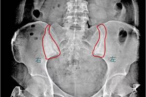 双侧髂骨致密性骨炎有没有好的办法治疗?