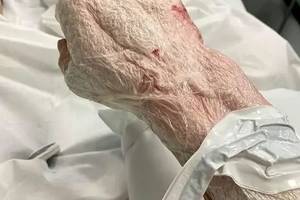 34岁男子手被割伤后染上恐怖食肉细菌,只能看着右手被"吃掉"