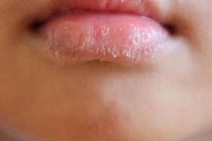 嘴唇干裂,起皮,是怎么回事,又该怎么解决?这次给你说明白!