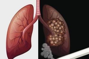 肺癌不痛不痒没知觉?这3处的疼痛感,可能是肺部在向你报信