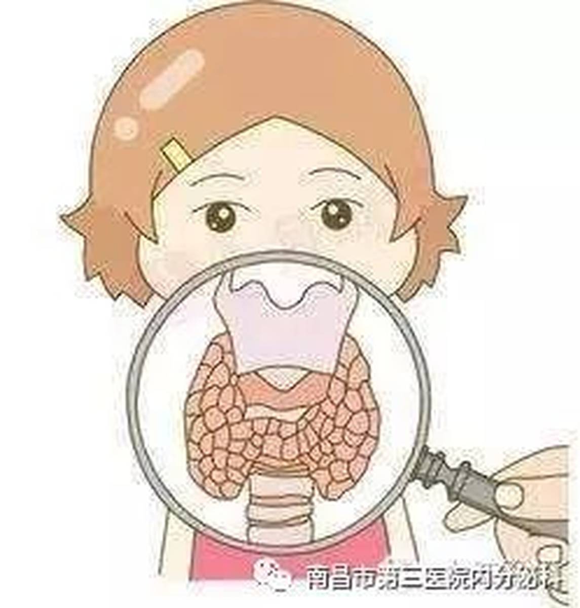 脖子痛，警惕亚急性甲状腺炎！
