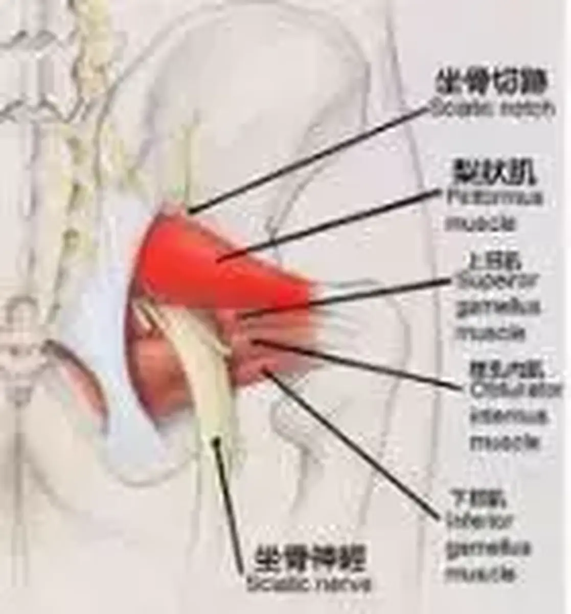 别大意，你有可能是得了梨状肌综合征！！！