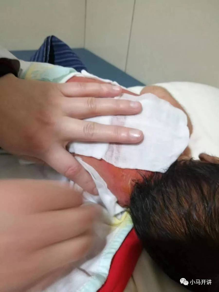 【揪心】又一小孩洗澡被烫伤！这次居然是在医院里！