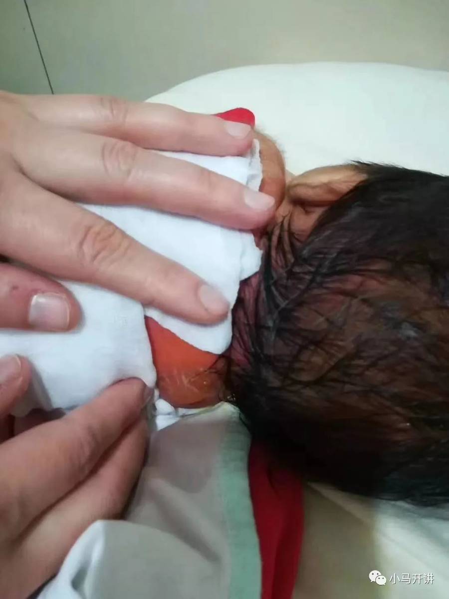 【揪心】又一小孩洗澡被烫伤！这次居然是在医院里！