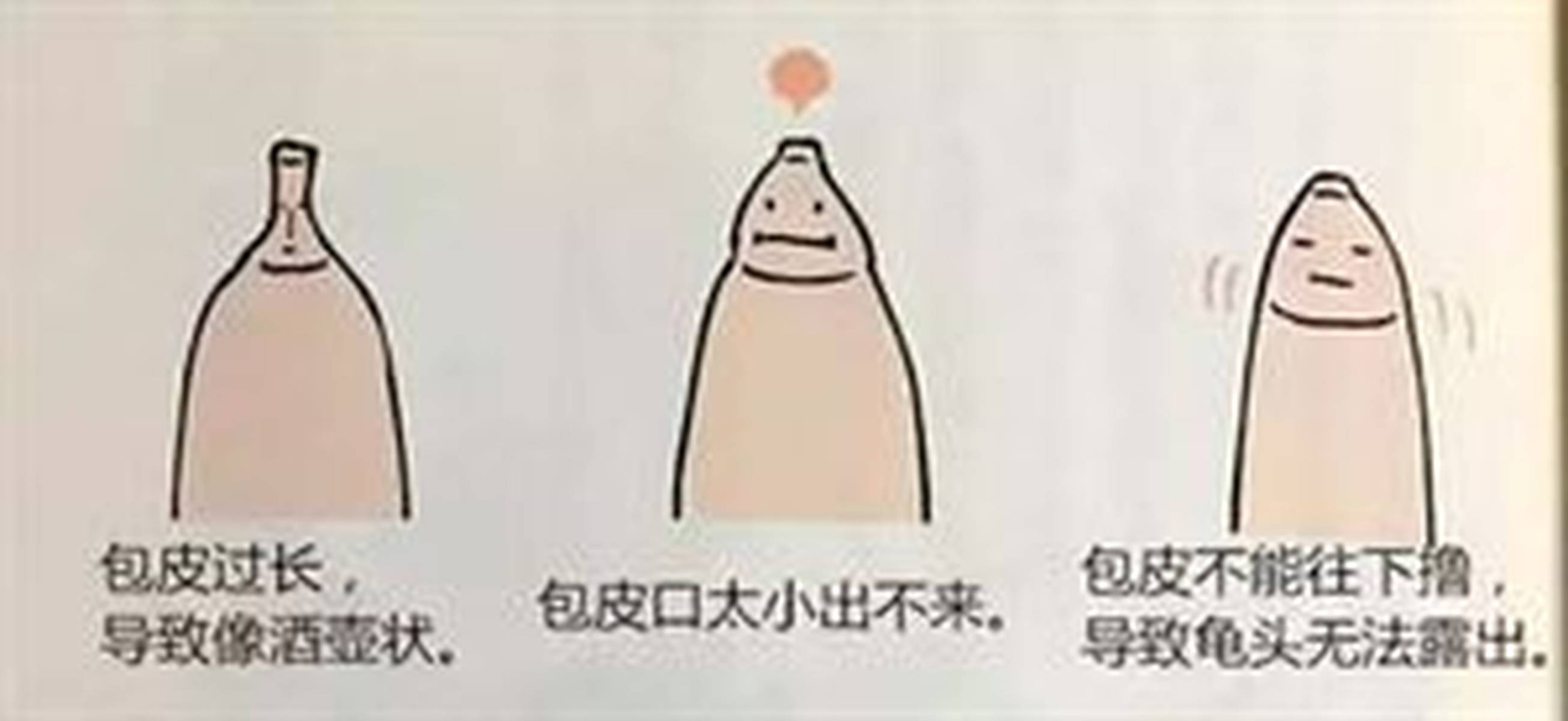 寒假快来了，又到了男孩们排队割包皮的季节！许多家长都会纠结：男孩子都要割包皮吗？