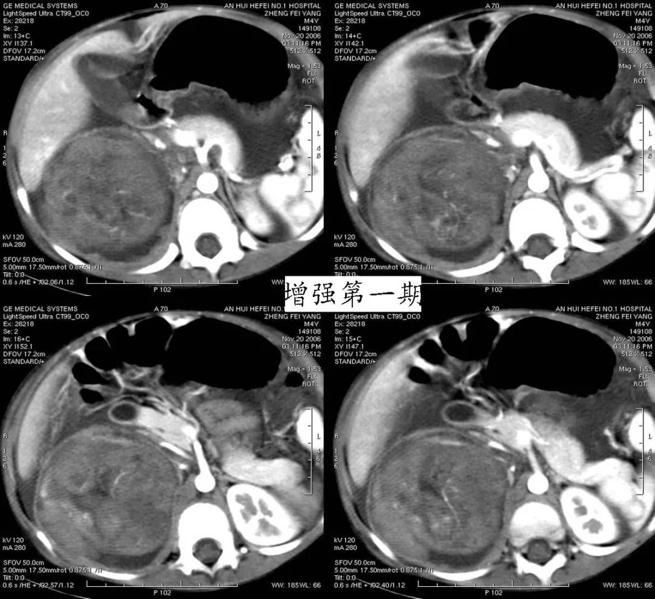 肾母细胞瘤，等你分析 | 读片专栏1137期