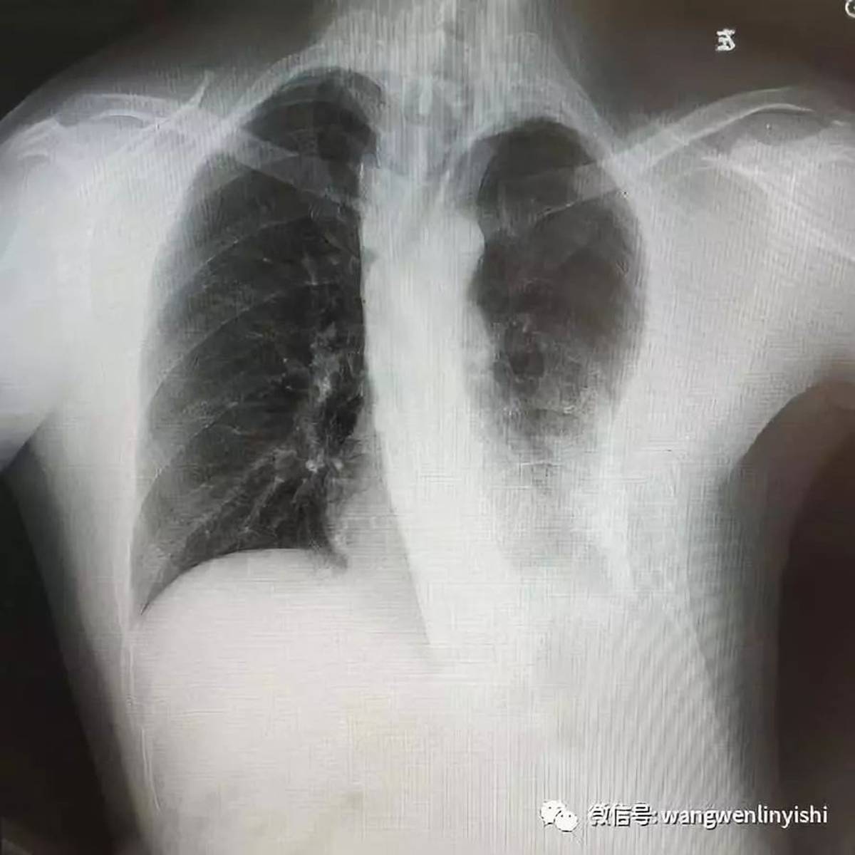 今天手术：继发性胸廓畸形（脓胸合并胸壁塌陷）矫正术