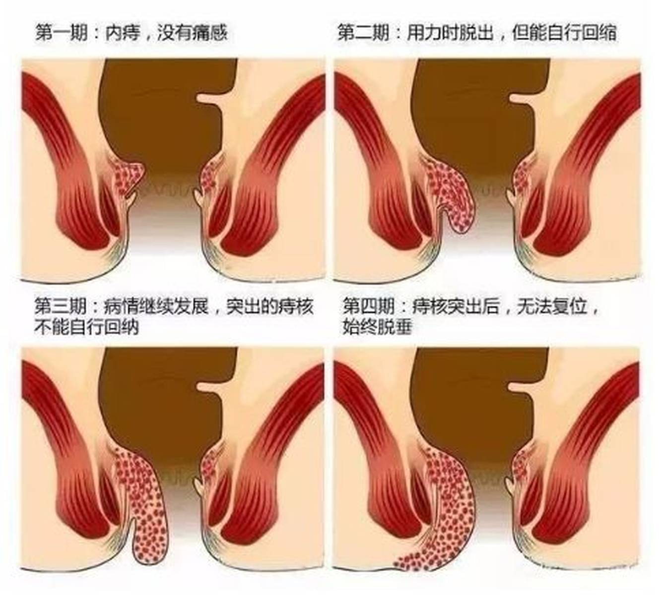 之前只有一个痔疮，现在好几个，是怎么回事呢？