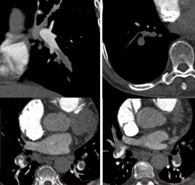 许荆棘:Documents肺栓塞的CTPA诊断