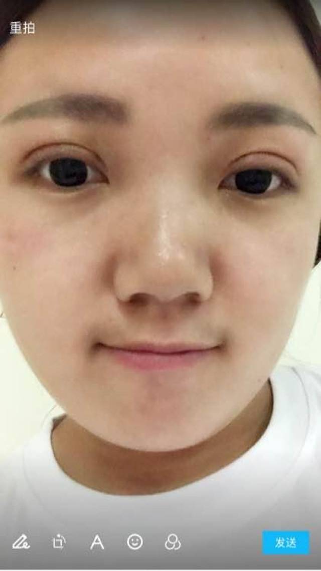 肿泡眼刚开始不懂,就被人坑了,全切双眼皮修复