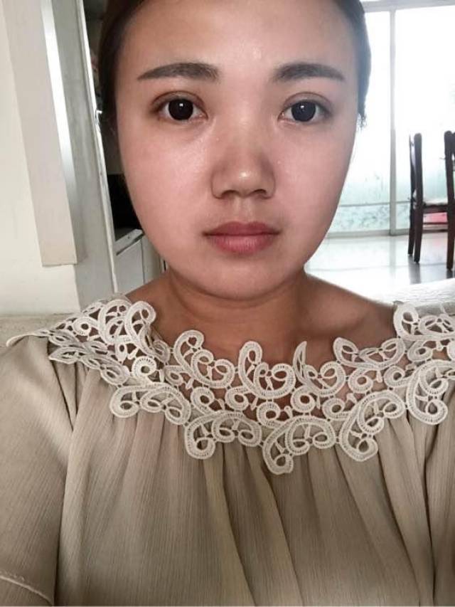 肿泡眼刚开始不懂,就被人坑了,全切双眼皮修复