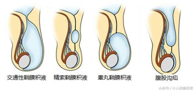 宝宝私处那些事,小心疝气作怪!小儿推拿能帮上忙