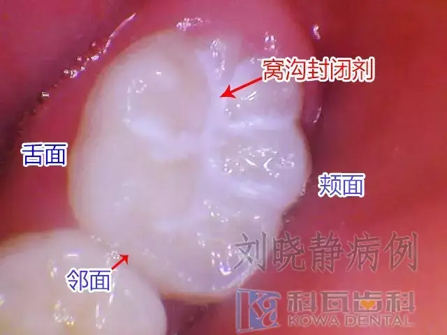 想要孩子牙齿好,3岁就可以带他去做窝沟封闭了