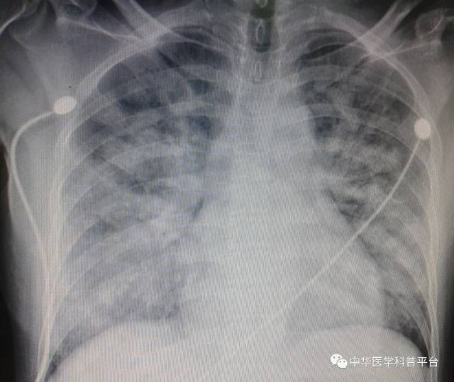 别走,您的肺炎"大发"了