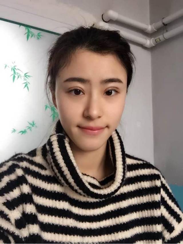韩式三点双眼皮恢复半个月,大小眼严重,还有救嘛
